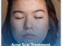 Acne-Scar-Treatment (1)