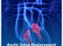 Aortic-Valve-Replacement Aortic-Valve-Replacement