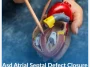 Asd-Atrial-Septal-Defect-Closure Asd-Atrial-Septal-Defect-Closure