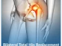 Bilateral-Total-Hip-Replacement