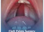 Cleft-Palate-Surgery Cleft-Palate-Surgery