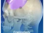 Cranioplasty