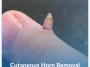 Cutaneous-Horn-Removal Cutaneous-Horn-Removal