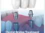 Dental-Bridge-Treatment (1) Dental-Bridge-Treatment (1)