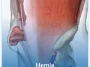 Hernia