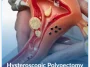 Hysteroscopic-Polypectomy Hysteroscopic-Polypectomy
