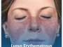 Lupus-Erythematosus