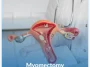 Myomectomy