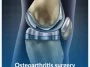 Osteoarthritis-surgery