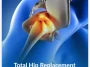 Total-Hip-Replacement