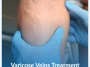Varicose-Veins-Treatment Varicose-Veins-Treatment
